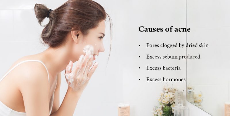 Causes of acne